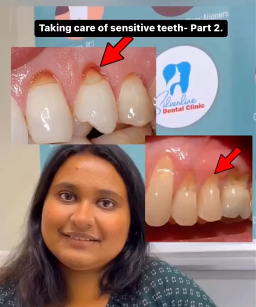 Taking care of sensitive teeth- Part 2